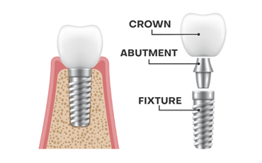 Dental Implants