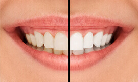 Teeth Whitening