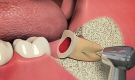 Extractions / Oral Surgery