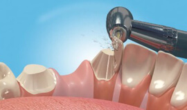 Dental Bridges