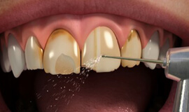 Porcelain Veneers